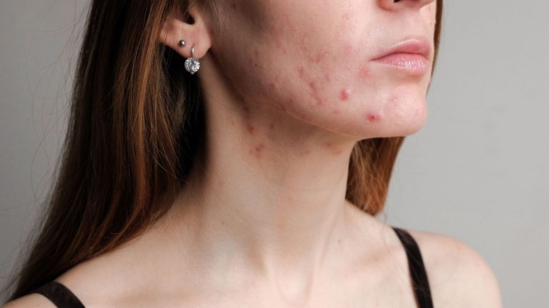limpieza-facial-para-el-acne