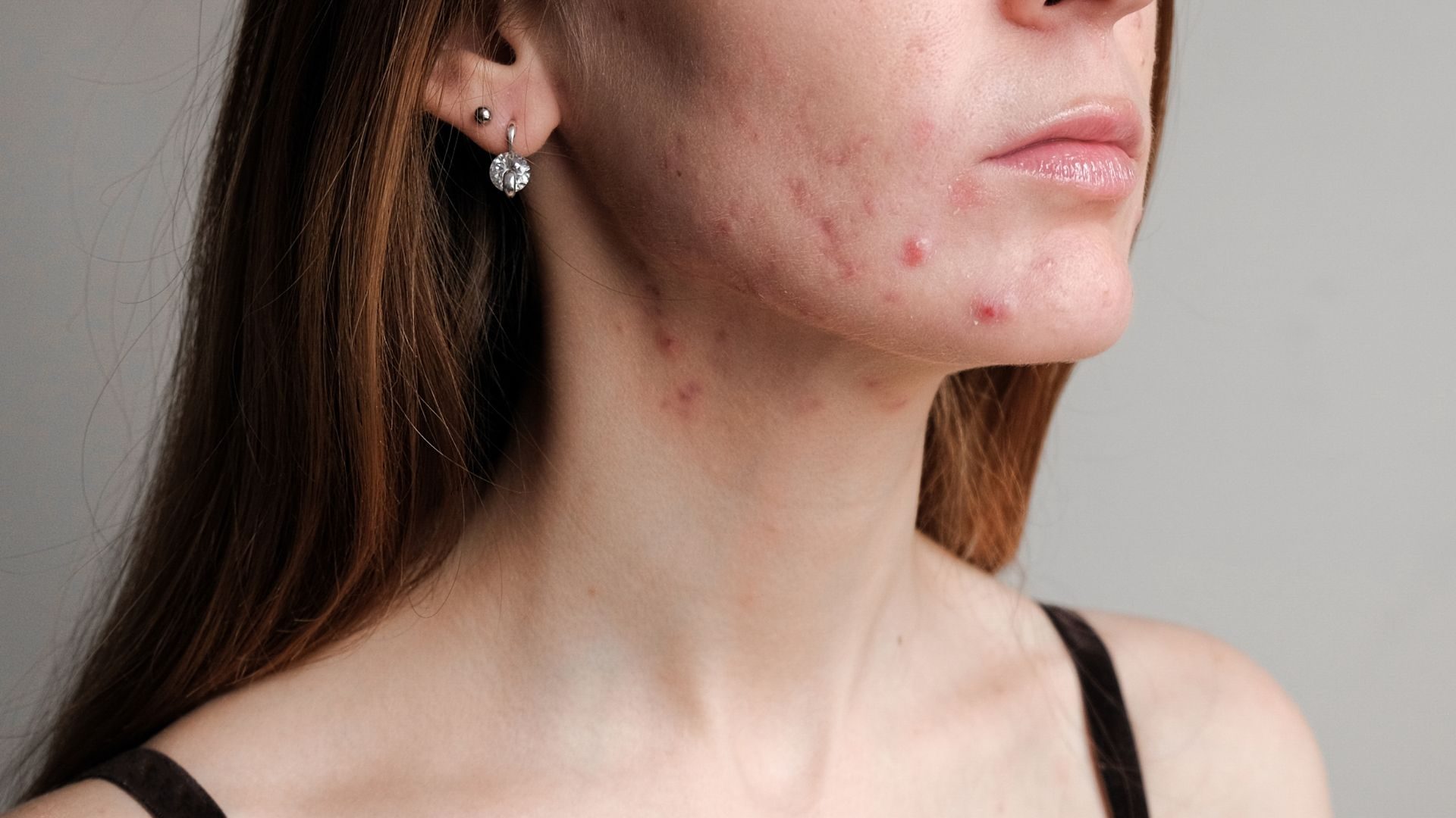 limpieza-facial-para-el-acne